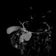 Serous cystadenoma of pancreas, cystadenoma, cystic tumour: MRI - Magnetic Resonance Imaging